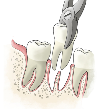 Root Canal Treatment